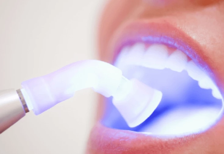 Відбілювання зубів ультрафіолет