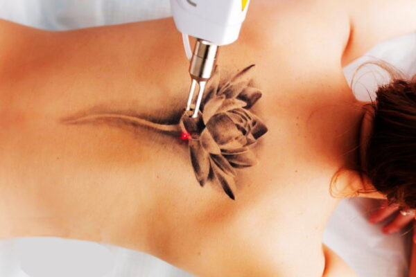 Особенности процедуры удаления татуировки лазером