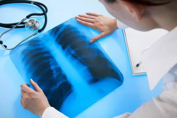 Смертность от туберкулеза в Европе снова начала расти